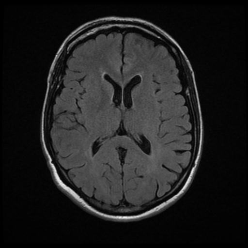 Frontotemporal dementia - language variant | Image | Radiopaedia.org