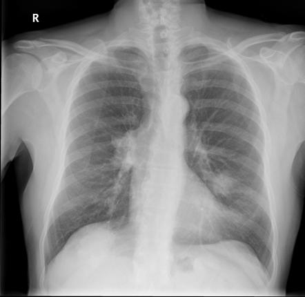 Hilum overlay sign | Radiology Reference Article | Radiopaedia.org