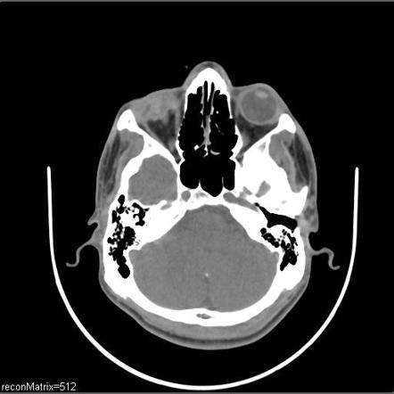 Globe rupture | Radiology Reference Article | Radiopaedia.org