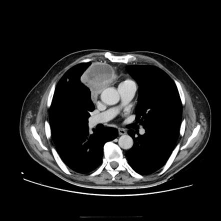 Cystic thymoma | Image | Radiopaedia.org