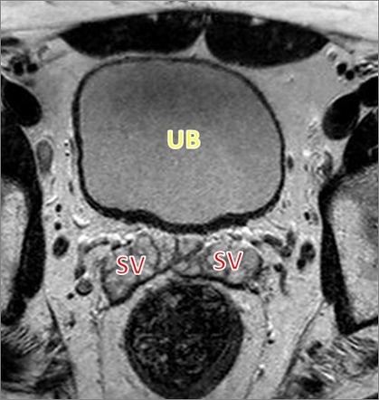 Normal prostate (MRI) | Image | Radiopaedia.org