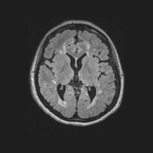 Multiple sclerosis: advanced | Image | Radiopaedia.org