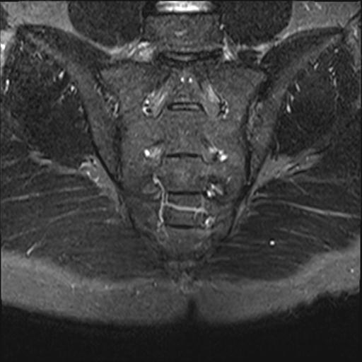 Normal sacroiliac joints (MRI) | Image | Radiopaedia.org