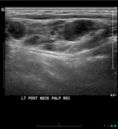 Recurrent cystic hygroma - adult | Image | Radiopaedia.org