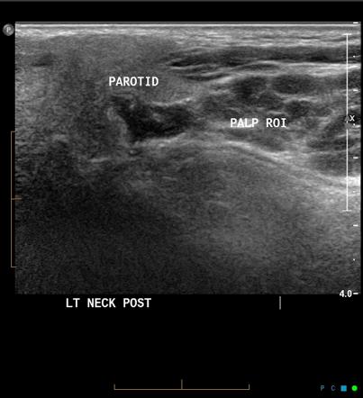 Recurrent cystic hygroma - adult | Image | Radiopaedia.org