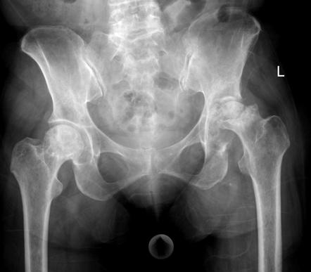 Bilateral femoral head avascular necrosis | Radiology Case ...