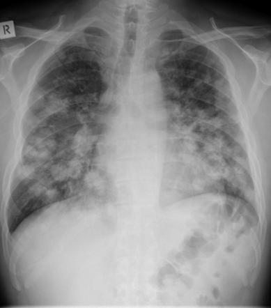 Pulmonary aspergillosis | Radiology Reference Article | Radiopaedia.org