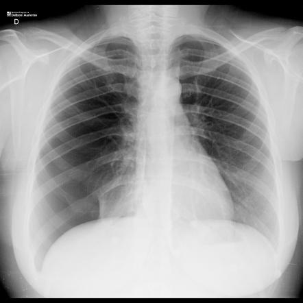 Menstruation-related spontaneous pneumothorax | Image | Radiopaedia.org