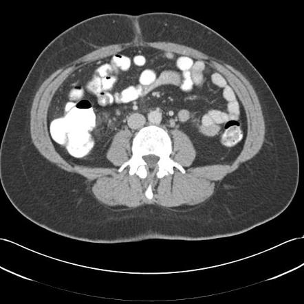 Acute appendicitis | Radiology Case | Radiopaedia.org