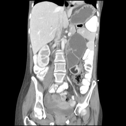 Closed loop obstruction | Image | Radiopaedia.org