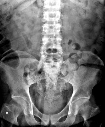 Ductus Deferens Calcification 