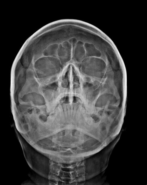 Nasal sinus clearance cyst