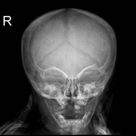 Neuroblastoma (craniocerebral metastases) | Radiology Reference Article ...