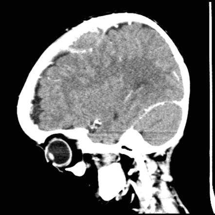 Neuroblastoma with skull metastases | Image | Radiopaedia.org