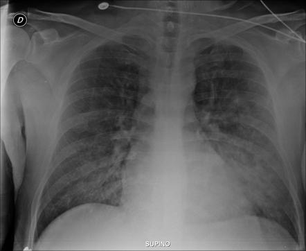 Crack lung | Radiology Reference Article | Radiopaedia.org