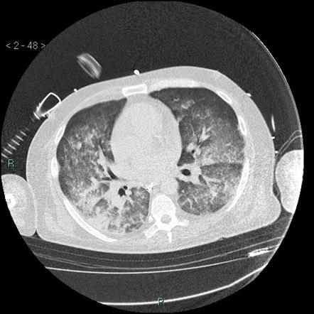 Crack lung | Radiology Reference Article | Radiopaedia.org