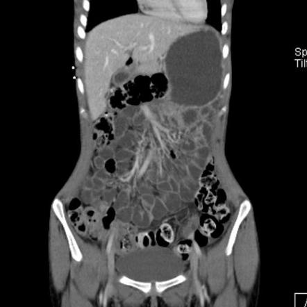 Normal CT enterography | Image | Radiopaedia.org