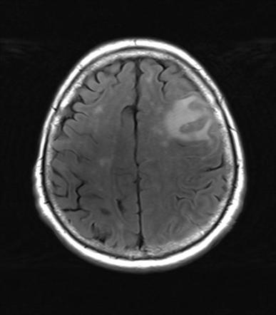 Inflammatory Cerebral Amyloid Angiopathy | Radiology Reference Article ...