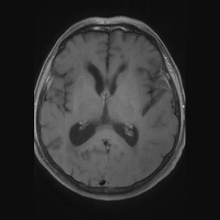 Amyloid angiopathy with inflammation | Image | Radiopaedia.org