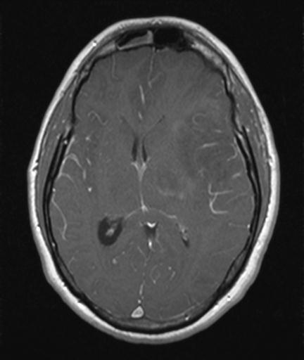 Inflammatory demyelinating pseudotumor | Image | Radiopaedia.org