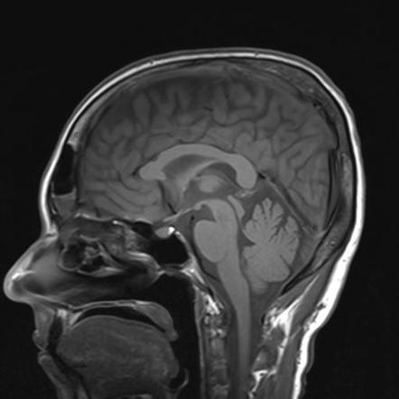 Autoimmune limbic encephalitis | Radiology Case | Radiopaedia.org