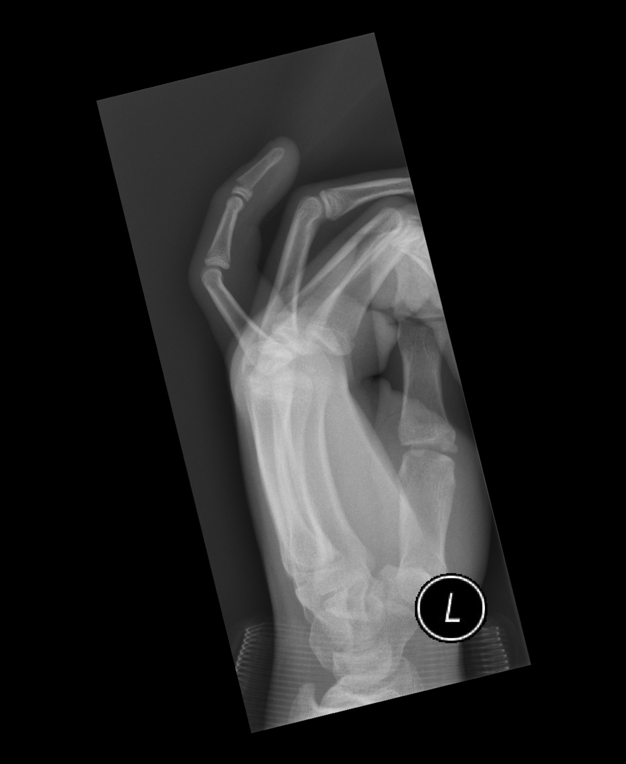 Salter Harris Type 1 Fracture Finger Image