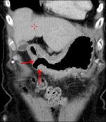 gastritis | Search | Radiopaedia.org