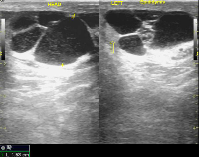 Scrotal Ultrasound Multiple Pathology Image 4425