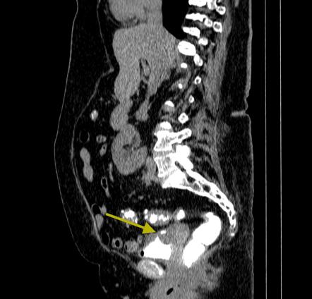 Colovesical fistula | Radiology Reference Article | Radiopaedia.org