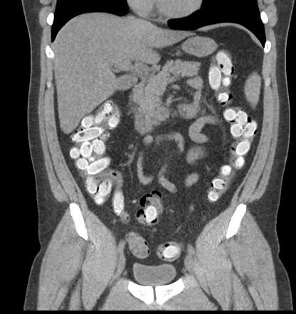 Recreational drug use (radiological manifestations) | Radiology ...