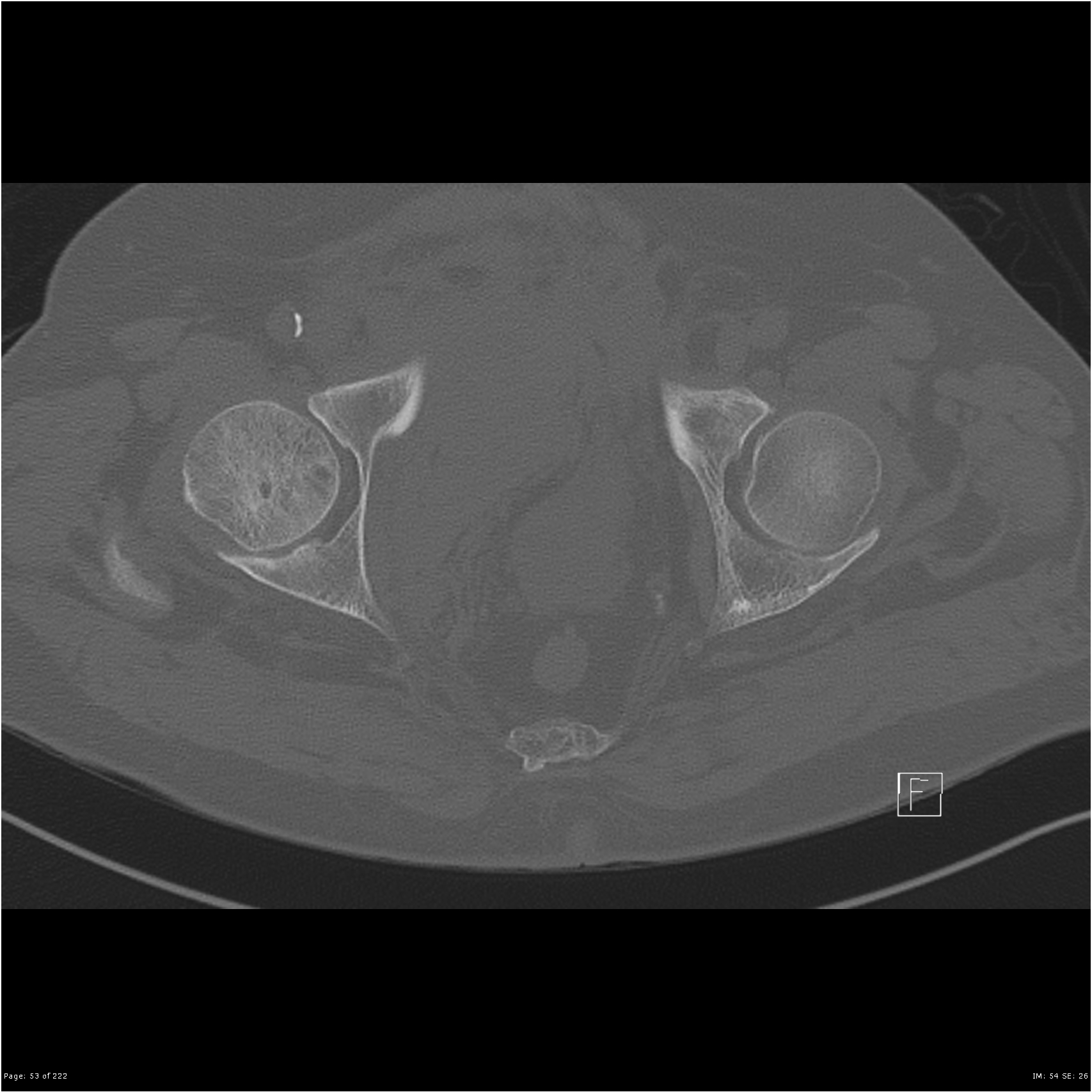 Diastasis Of The Symphysis Pubis Image