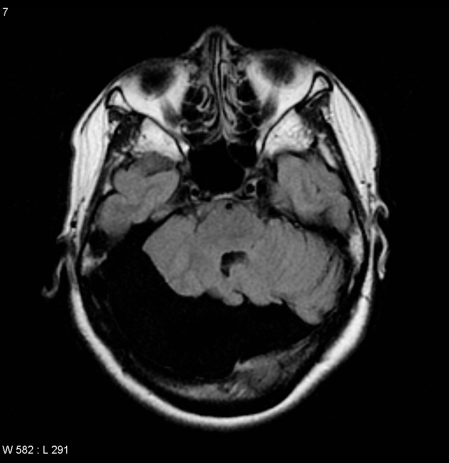 Arachnoid Cyst Posterior Fossa Image 8013