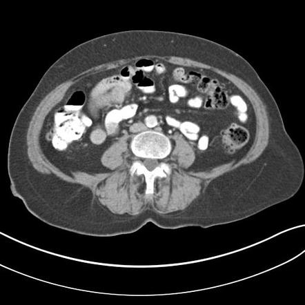 Diverticulitis with colovesical fistula | Radiology Case | Radiopaedia.org