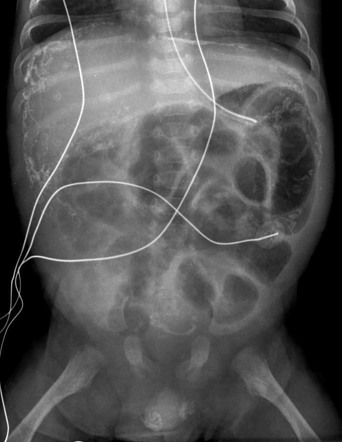 Meconium peritonitis | Radiology Reference Article | Radiopaedia.org