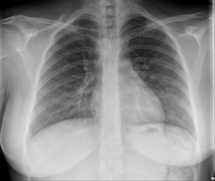 Right-sided Aortic Arch 