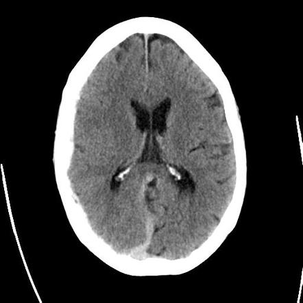 Acute subdural hemorrhage | Radiology Case | Radiopaedia.org