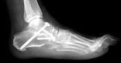 Pes planus | Radiology Reference Article | Radiopaedia.org