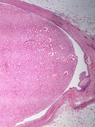 Medullary nephrocalcinosis (histology) | Image | Radiopaedia.org