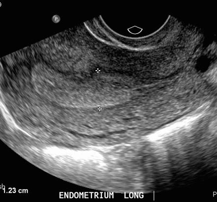 Endometrial Thickness | Radiology Reference Article | Radiopaedia.org