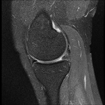 Meniscal ossicle | Image | Radiopaedia.org