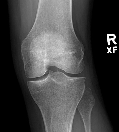 Meniscal ossicle | Image | Radiopaedia.org