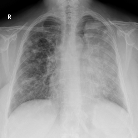 Luftsichel sign (lungs) | Radiology Reference Article | Radiopaedia.org