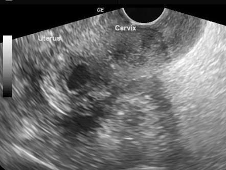 Carcinoma of the cervix - squamous cell | Radiology Case | Radiopaedia.org