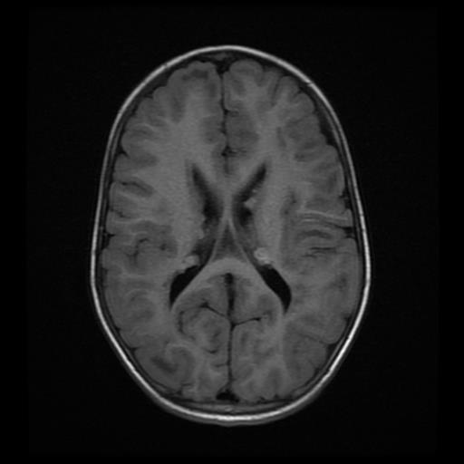 Tuberous sclerosis | Image | Radiopaedia.org