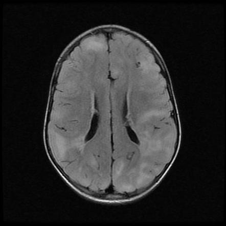 Playlist 'gd: Paediatrics - Cns - Phakomatoses' By Dr Gurjeet Dulku