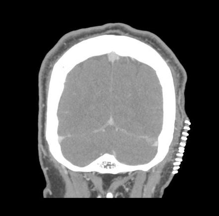 Transverse sinus thrombosis | Radiology Case | Radiopaedia.org