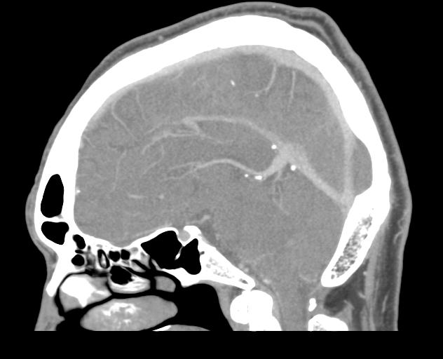 Transverse Sinus Thrombosis Image