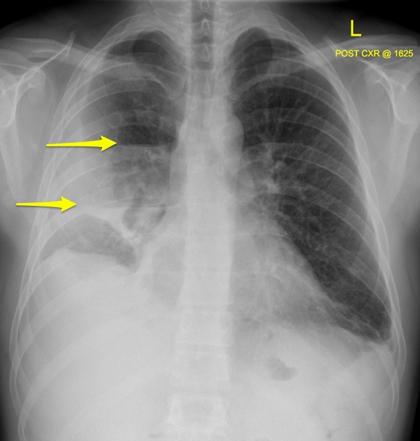 Viewing playlist: Røntgen Thorax basalt Kompetancekort | Radiopaedia.org