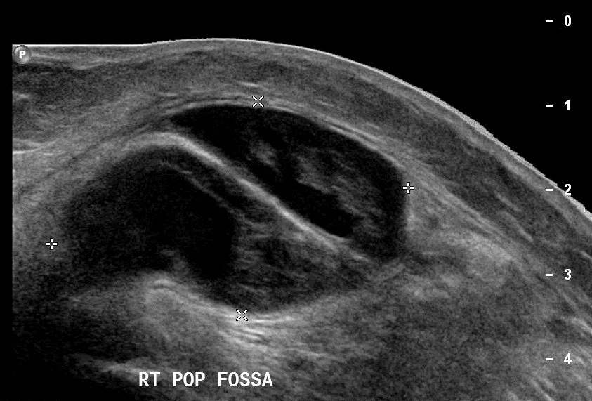 Baker Cyst Hemorrhagic Image