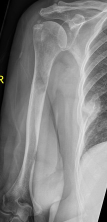 Endosteal scalloping | Radiology Reference Article | Radiopaedia.org